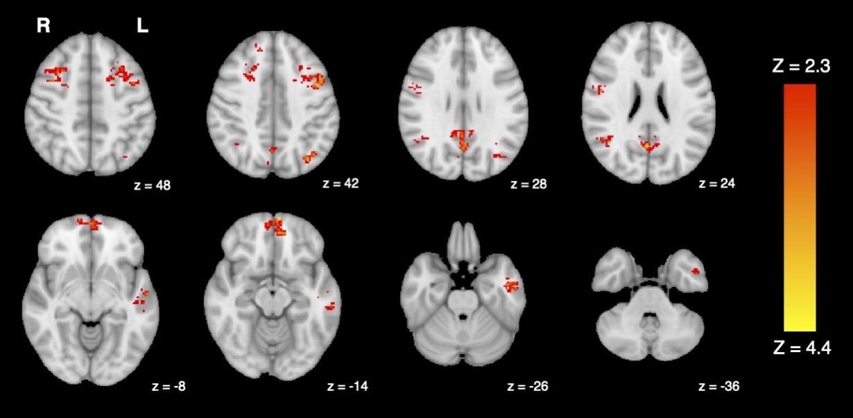 Brain scans with red dots show decreased functional connectivity after exposure to car exhaust